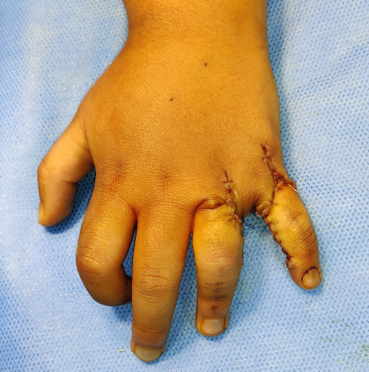 Congenital Reconstruction